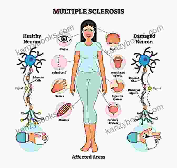 Managing The Symptoms Of Multiple Sclerosis Words Escape Me: Life After Being Diagnosed With Multiple Sclerosis