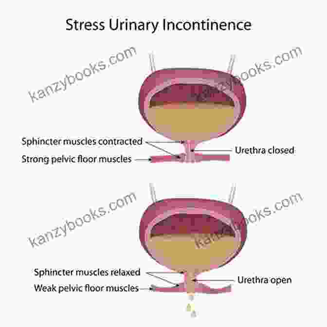 Urinary Incontinence Can Be Caused By A Variety Of Conditions, Including Overactive Bladder, Weak Pelvic Floor Muscles, And Urinary Tract Infections. Algorithms In Differential Diagnosis: How To Approach Common Presenting Complaints In Adult Patients For Medical Students And Junior Doctors