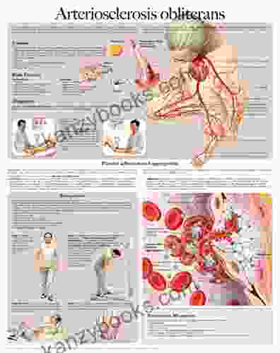 Arteriosclerosis Obliterans E Chart: Full Illustrated